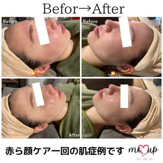 Meupニキビ専門店 背中/ハーブ/肌管理のその他イメージ