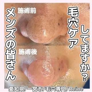 毛穴/シミ肝斑/脱毛 横山梨里のエステ・リラクイメージ