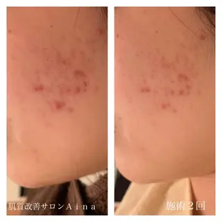 セミロング パーマ ヘアアレンジ キッズ ネイル マツエク・マツパ ニキビ跡専門サロン Ainaのエステ・リラクイメージ