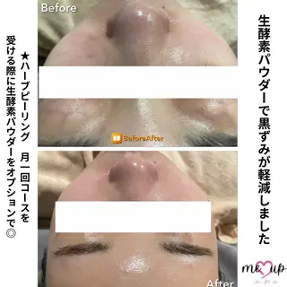 Meupニキビ専門店 背中/ハーブ/肌管理のその他イメージ