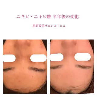 ロング カラー パーマ キッズ ネイル マツエク・マツパ ニキビ跡専門サロン Ainaのエステ・リラクイメージ