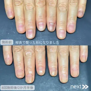 ネイル 美爪&巻き爪ケア❤️ ネイルサロンNANOのネイルデザイン