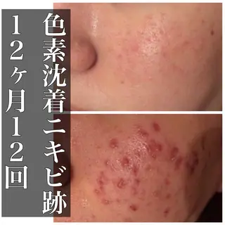 セミロング カラー パーマ ヘアアレンジ メンズ キッズ ネイル マツエク・マツパ ニキビ・肌質改善専門 ♡人生が変わるサロンのエステ・リラクイメージ
