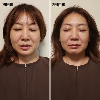 即効⚡小顔美容鍼🪡 むくみたるみケア鍼!のエステ・リラクイメージ