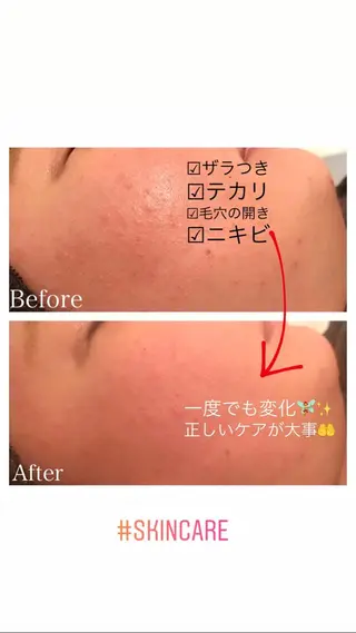 セミロング ヘアアレンジ ネイル マツエク・マツパ ニキビ跡専門サロン Ainaのエステ・リラクイメージ