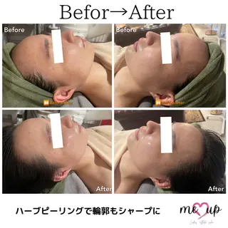 Meupニキビ専門店 背中/ハーブ/肌管理のその他イメージ