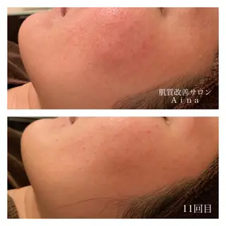 ロング カラー パーマ ヘアアレンジ メンズ キッズ ネイル マツエク・マツパ ニキビ跡専門サロン Ainaのエステ・リラクイメージ