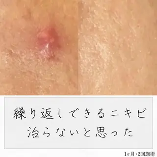 ニキビ経験者が施術 する専門サロン🌻のエステ・リラクイメージ