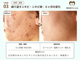 ニキビケア・毛穴専門 mele|もりぞののエステ・リラクイメージ