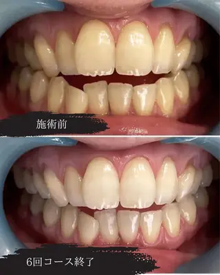 メンズ 東区香椎歯のセルフホ ワイトニングGLOWのその他イメージ