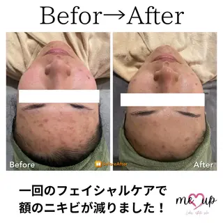Meupニキビ専門店 背中/ハーブ/肌管理のその他イメージ