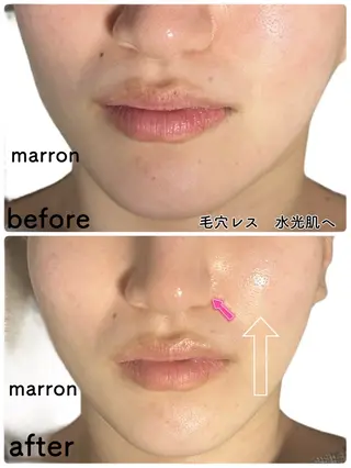 痩身ハイパーナイフ ララピールリアボーテのエステ・リラクイメージ
