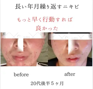 シミニキビ改善 小顔サロンのエステ・リラクイメージ