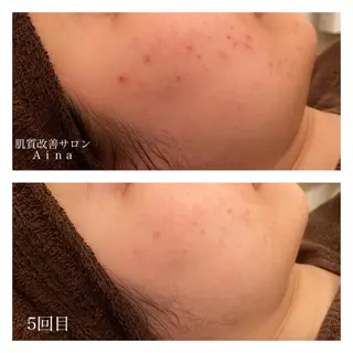 ミディアム カラー パーマ ヘアアレンジ メンズ キッズ ネイル マツエク・マツパ ニキビ跡専門サロン Ainaのエステ・リラクイメージ