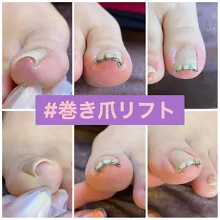 ネイル ♢ME2ROOM♢ #巻き爪#リラクのネイルデザイン