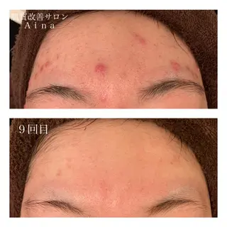 セミロング カラー パーマ ヘアアレンジ メンズ キッズ ネイル マツエク・マツパ ニキビ跡専門サロン Ainaのエステ・リラクイメージ