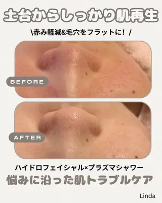 小顔&毛穴・肌質改善 LINDA西宮 AIのエステ・リラクイメージ