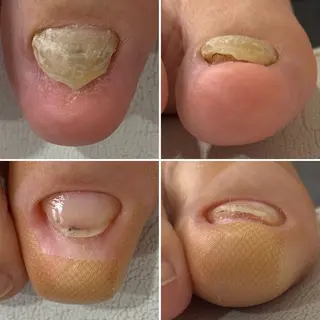 ネイル 巻爪無料モデル募集 ✨🦶MEGUMIのネイルデザイン