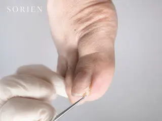 フットケア 巻き爪のネイルデザイン