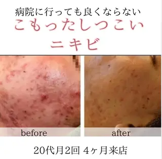 シミニキビ改善 小顔サロンのエステ・リラクイメージ