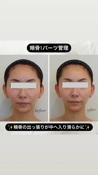 頬骨/面長/たるみ 🥺無痛小顔矯正のエステ・リラクイメージ