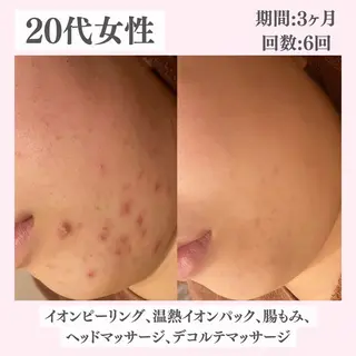 ニキビ・肌質改善専門 ♡人生が変わるサロンのエステ・リラクイメージ
