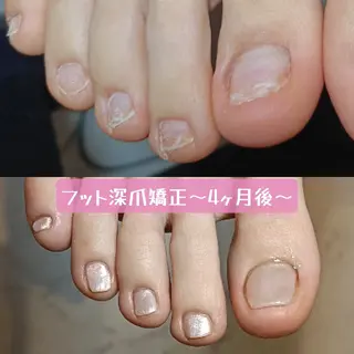 ネイル 深爪矯正/爪育成ケア manie nailのネイルデザイン