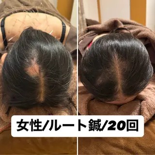 即小顔♥️美容鍼× ハーブピーリングのその他イメージ