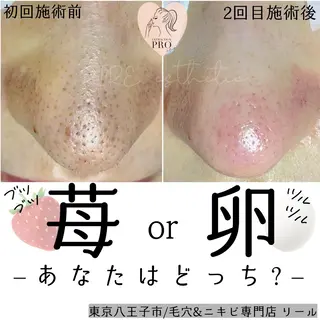 毛穴特化エステ -リールのエステ・リラクイメージ