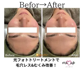 Meupニキビ専門店 背中/ハーブ/肌管理のその他イメージ