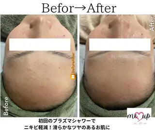 Meupニキビ専門店 背中/ハーブ/肌管理のその他イメージ