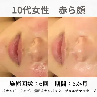 重度ニキビ専門🌼 ダウンタイムなしのエステ・リラクイメージ