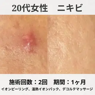 繰り返すニキビ跡専門 根本改善のエステ・リラクイメージ