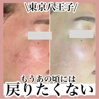 毛穴特化エステ -リールのエステ・リラクイメージ