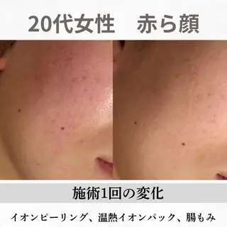 重度ニキビ専門🌷 ダウンタイムなしのエステ・リラクイメージ