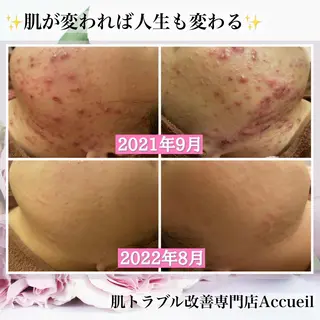 セミロング カラー パーマ ヘアアレンジ メンズ キッズ ネイル マツエク・マツパ アイブロウ ニキビ・肌質改善専門 ♡人生が変わるサロンのエステ・リラクイメージ