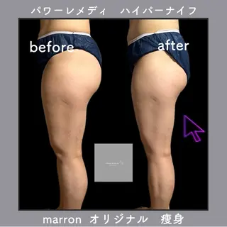 痩身ハイパーナイフ ララピールリアボーテのエステ・リラクイメージ