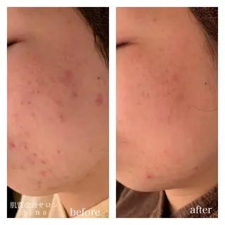 ショート カラー パーマ ヘアアレンジ メンズ キッズ ネイル マツエク・マツパ ニキビ跡専門サロン Ainaのエステ・リラクイメージ