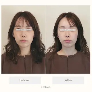 即効⚡小顔美容鍼🪡 むくみたるみケア鍼!のエステ・リラクイメージ