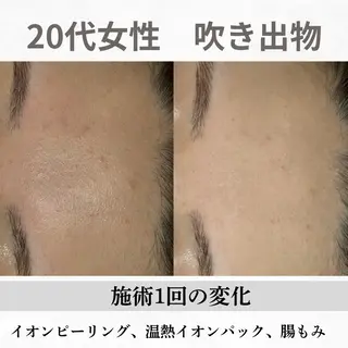 重度ニキビ専門🌼 ダウンタイムなしのエステ・リラクイメージ