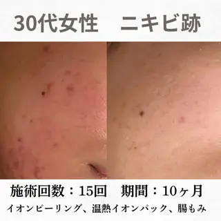 重度ニキビ専門🌼 ダウンタイムなしのエステ・リラクイメージ