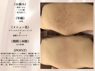 何をしても繰り返す ニキビ・ニキビ跡専門のエステ・リラクイメージ