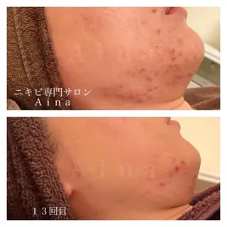 セミロング パーマ ヘアアレンジ メンズ キッズ ネイル マツエク・マツパ アイブロウ ニキビ跡専門サロン Ainaのエステ・リラクイメージ