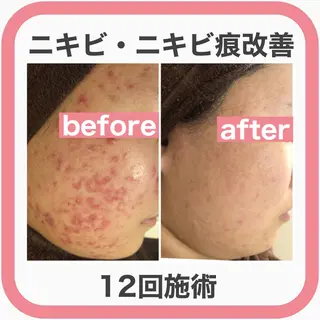 ミディアム ヘアアレンジ メンズ マツエク・マツパ アイブロウ ニキビ・肌質改善専門 ♡人生が変わるサロンのエステ・リラクイメージ