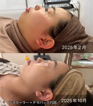 ielu〜毛穴ケア ハーブピーリングのエステ・リラクイメージ