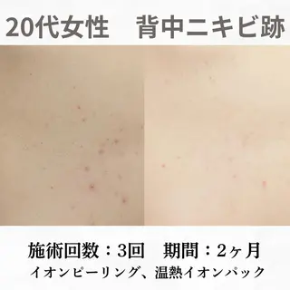 重度ニキビ専門🌷 ダウンタイムなしのエステ・リラクイメージ