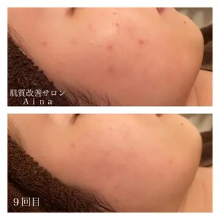 セミロング カラー パーマ ヘアアレンジ メンズ ネイル マツエク・マツパ ニキビ跡専門サロン Ainaのエステ・リラクイメージ