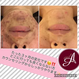 ミディアム カラー パーマ ヘアアレンジ メンズ キッズ ネイル マツエク・マツパ ニキビ・肌質改善専門 ♡人生が変わるサロンのエステ・リラクイメージ