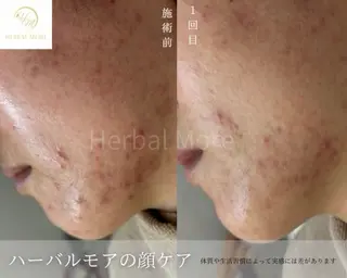 毛穴ニキビ肌改善専門 ハーブピーリング専門のエステ・リラクイメージ
