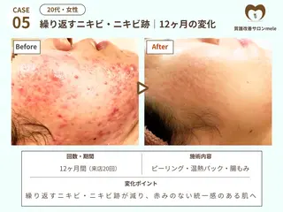 ニキビケア・毛穴専門 mele|もりぞののエステ・リラクイメージ